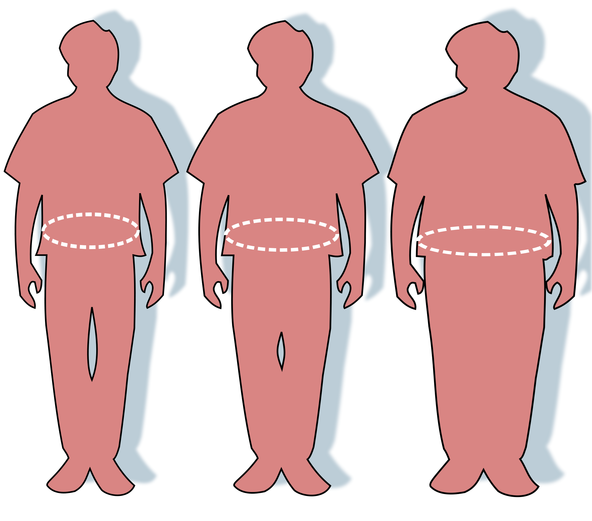 Weight loss surgery