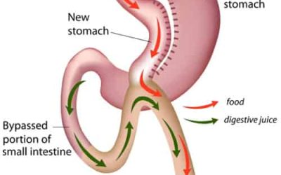 Gastric Bypass Surgery – The “Gold Standard” Weight Loss Surgery