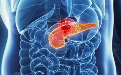 Disparities in Pancreatic Cancer Treatment