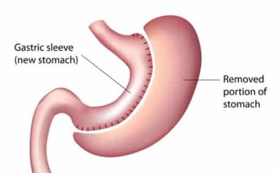 Sleeve Gastrectomy Surgery Information