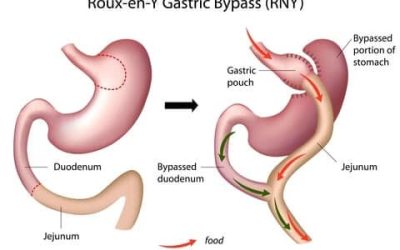 Gastric Bypass Surgery Information