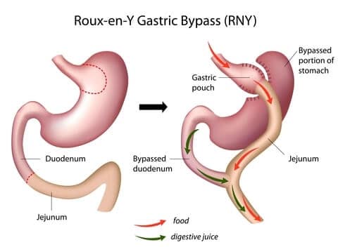 gastric bypass surgery sydney