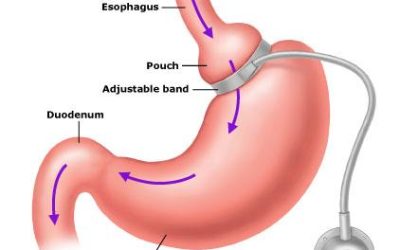 Gastric Band Surgery Information