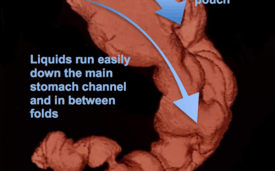 Introducing Endoscopic Sleeve Gastroplasty