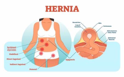 Hernia’s – A Quick Guide